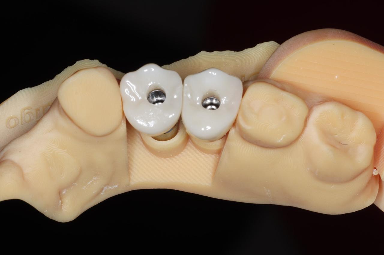 Coronas individuales sobre implantes